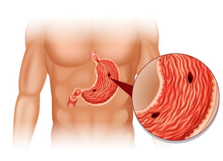 úlcera como causa de dolor debajo de la escápula izquierda en la espalda