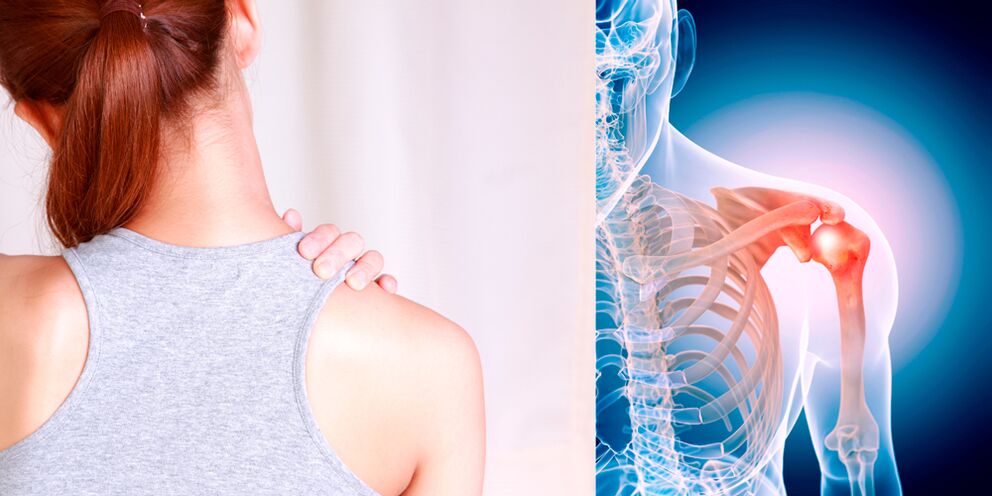 El desarrollo gradual de la osteoartritis del hombro conduce a un dolor persistente