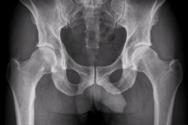 radiografía de la articulación de la cadera para el dolor