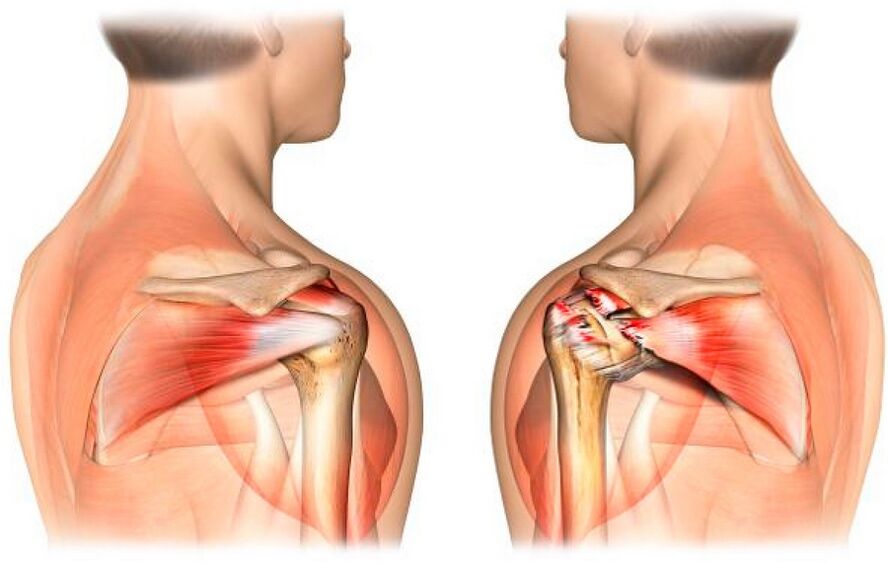 Un hombro sano con artrosis