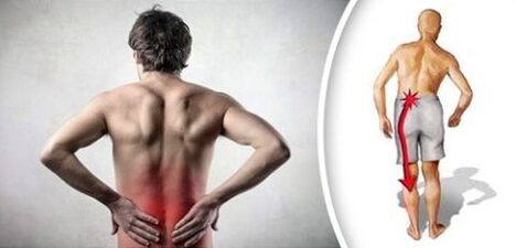 Síndrome de dolor con osteocondrosis lumbar emite piernas