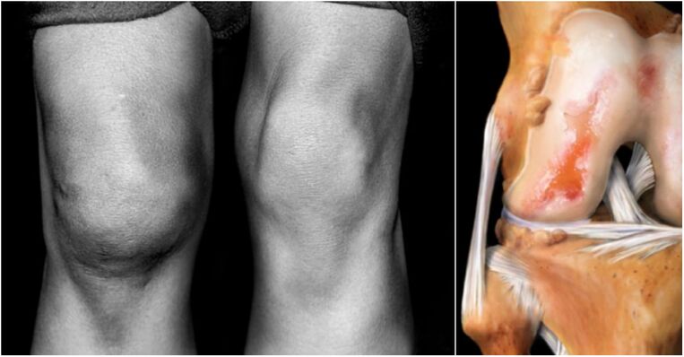 Artrosis de la articulación de la rodilla y dolor en las articulaciones