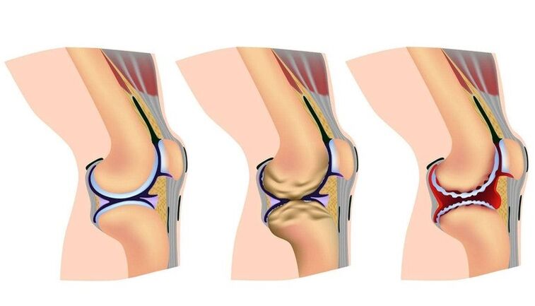 El nivel de deformación en la articulación de la rodilla para la artrosis