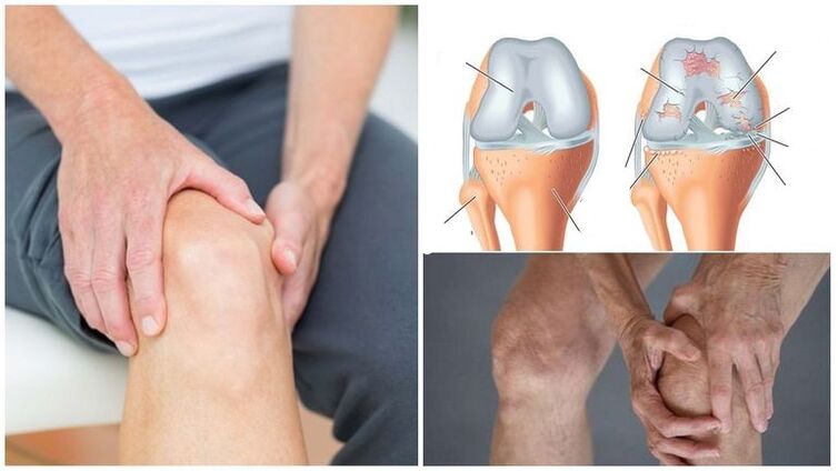 Síntomas de la artrosis de la rodilla de la articulación de la rodilla