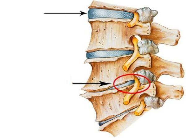 discos normales y dañados en la columna vertebral