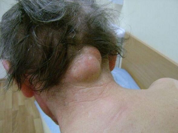 hinchazón en el cuello como causa de dolor