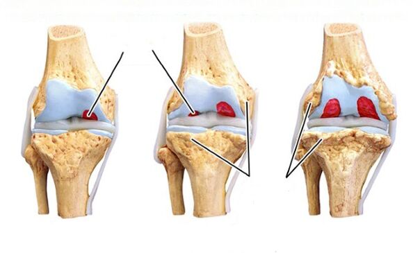 etapa de la artrosis de rodilla