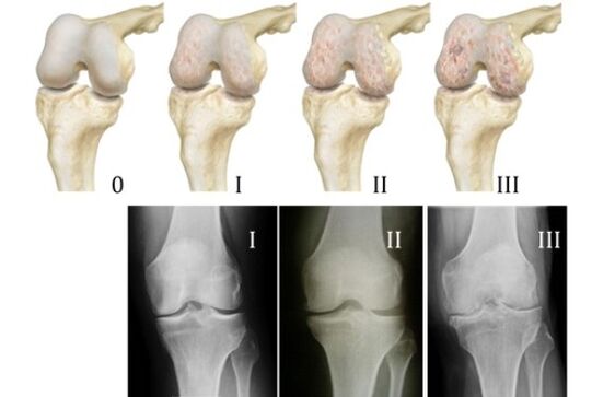 métodos para diagnosticar la artrosis de rodilla